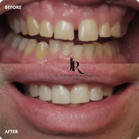 Before and after composite veneers: gaps between front teeth closed