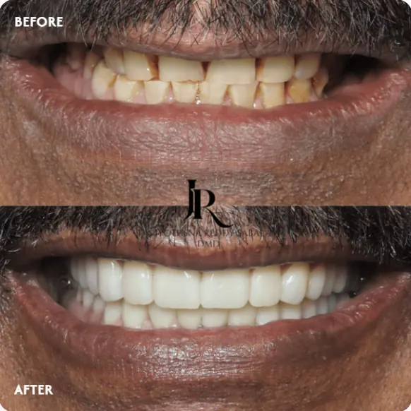 Before and after full mouth rehabilitation: worn, damaged teeth rebuilt