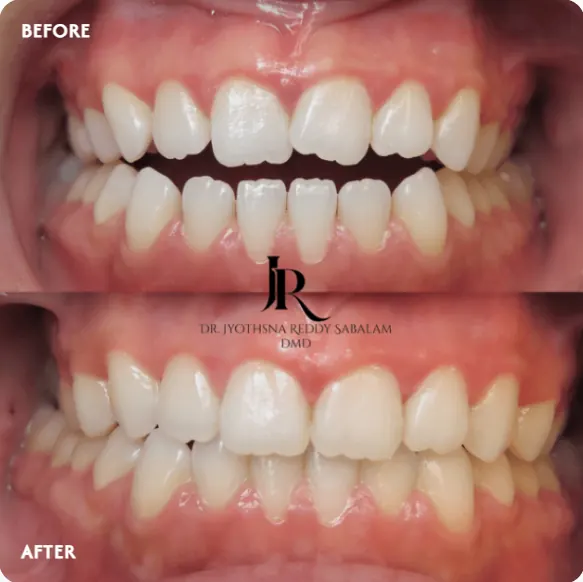 Before and after Invisalign: crowded teeth straightened