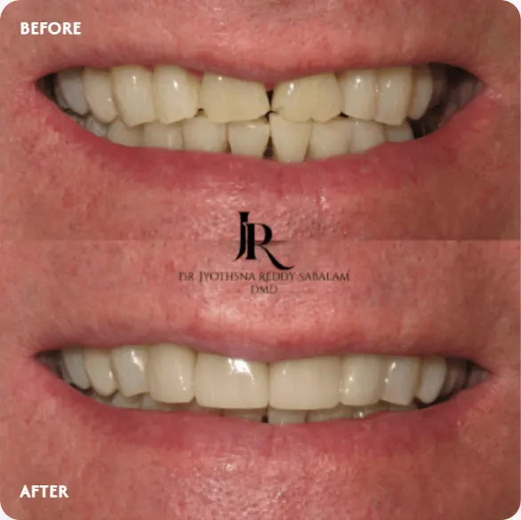 Before and after veneers: uneven front teeth made even in shape and color