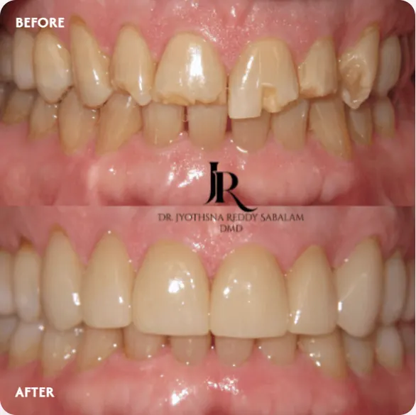 Before and after veneers: chipped, discolored front teeth replaced with even, natural-looking veneers